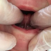 Baby en Borstvoeding Lactatiekundigen | Utrecht - Leidsche Rijn | Tongriem en lipband